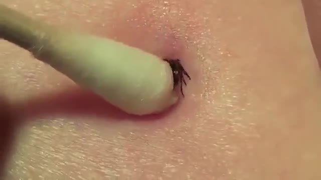 Как да извадим кърлеж у дома напълно безопасно – трябват ви само вода и клечка за уши