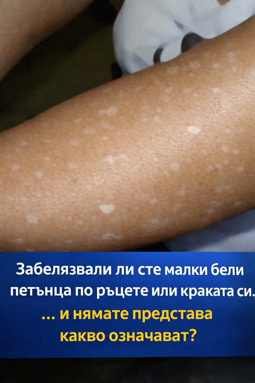 Забелязвали ли сте по ръцете или краката си малки бели петънца… и се чудите какво може да означават? Ето какво споделя специалист по темата.